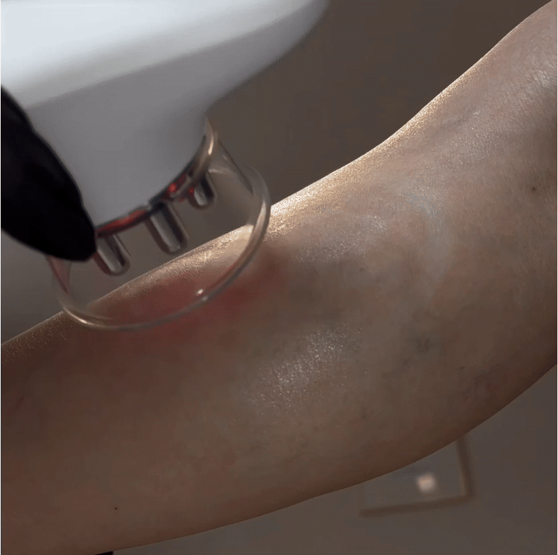 CelluWave - In nur 14 Tagen sichtbarer Linderung der Cellulite